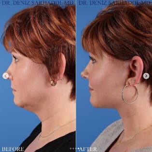 Face Procedures Before and After