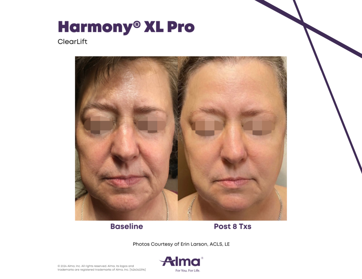 Harmony XL Pro ClearLift laser skin resurfacing - treatment of fine lines and wrinkles on the face before and after 8 treatments