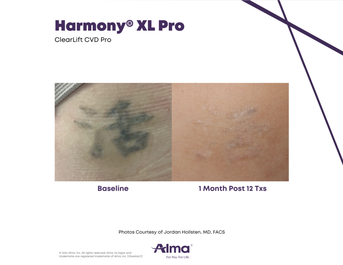 Harmony XL Pro laser tattoo removal - before and 1 month after 12 treatments