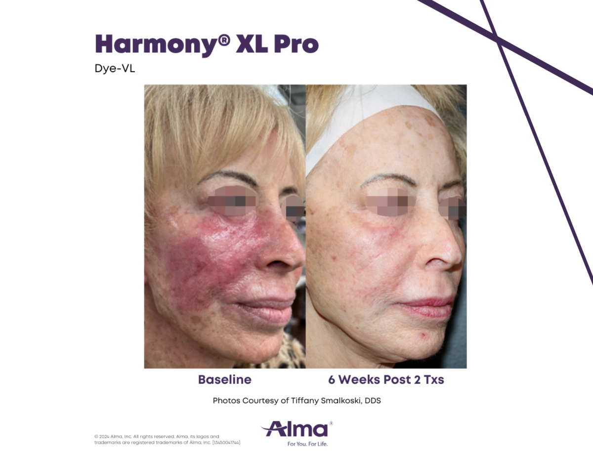 Harmony XL Pro laser skin resurfacing - treatment of visible veins and redness on the face before and 6 weeks after 2 treatments