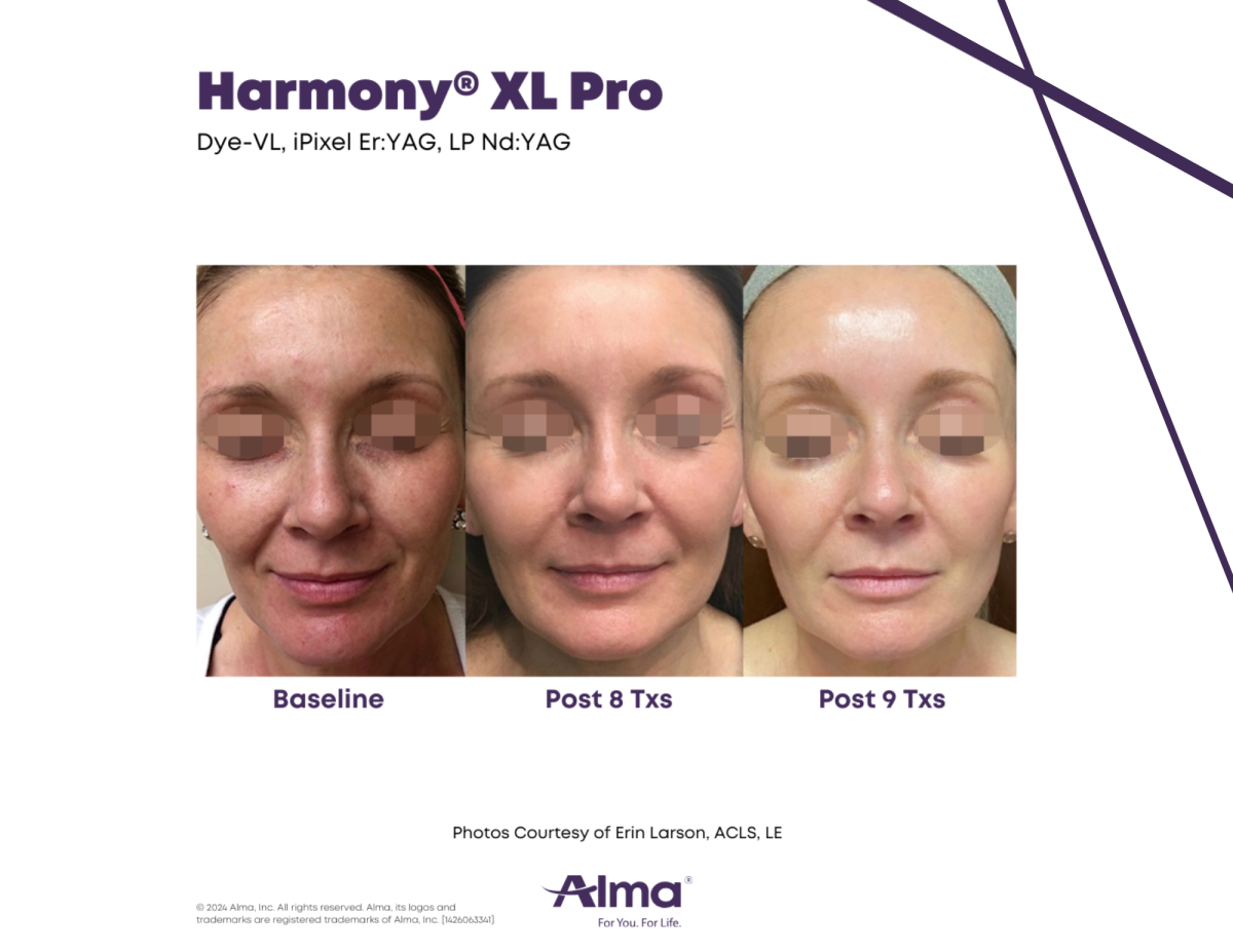 Harmony XL Pro laser skin resurfacing - treatment of fine lines and wrinkles on the face before, after 8 treatments, after 9 treatments