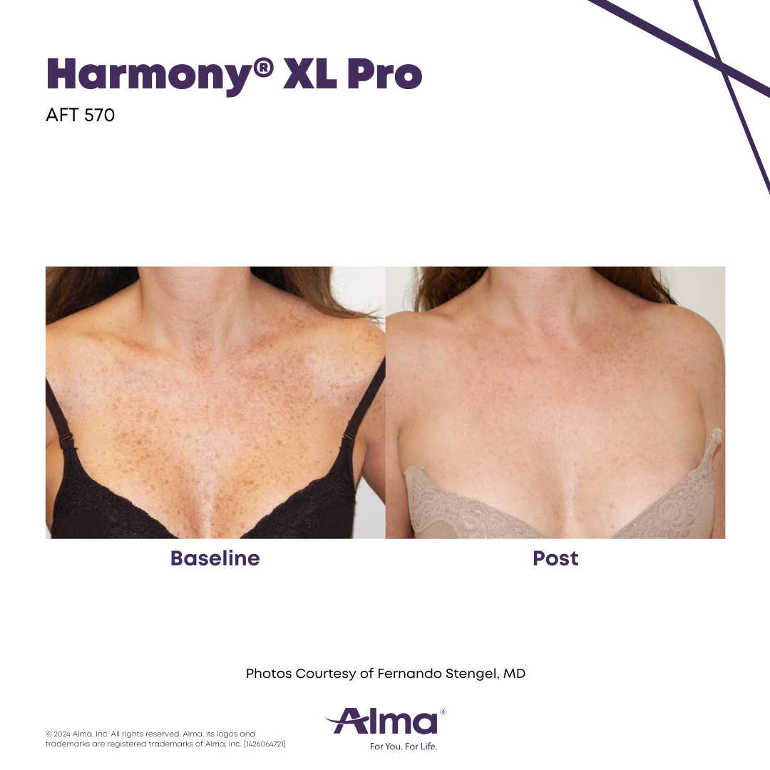 Harmony XL Pro laser skin resurfacing - treatment of dark spots on the chest before and after treatment