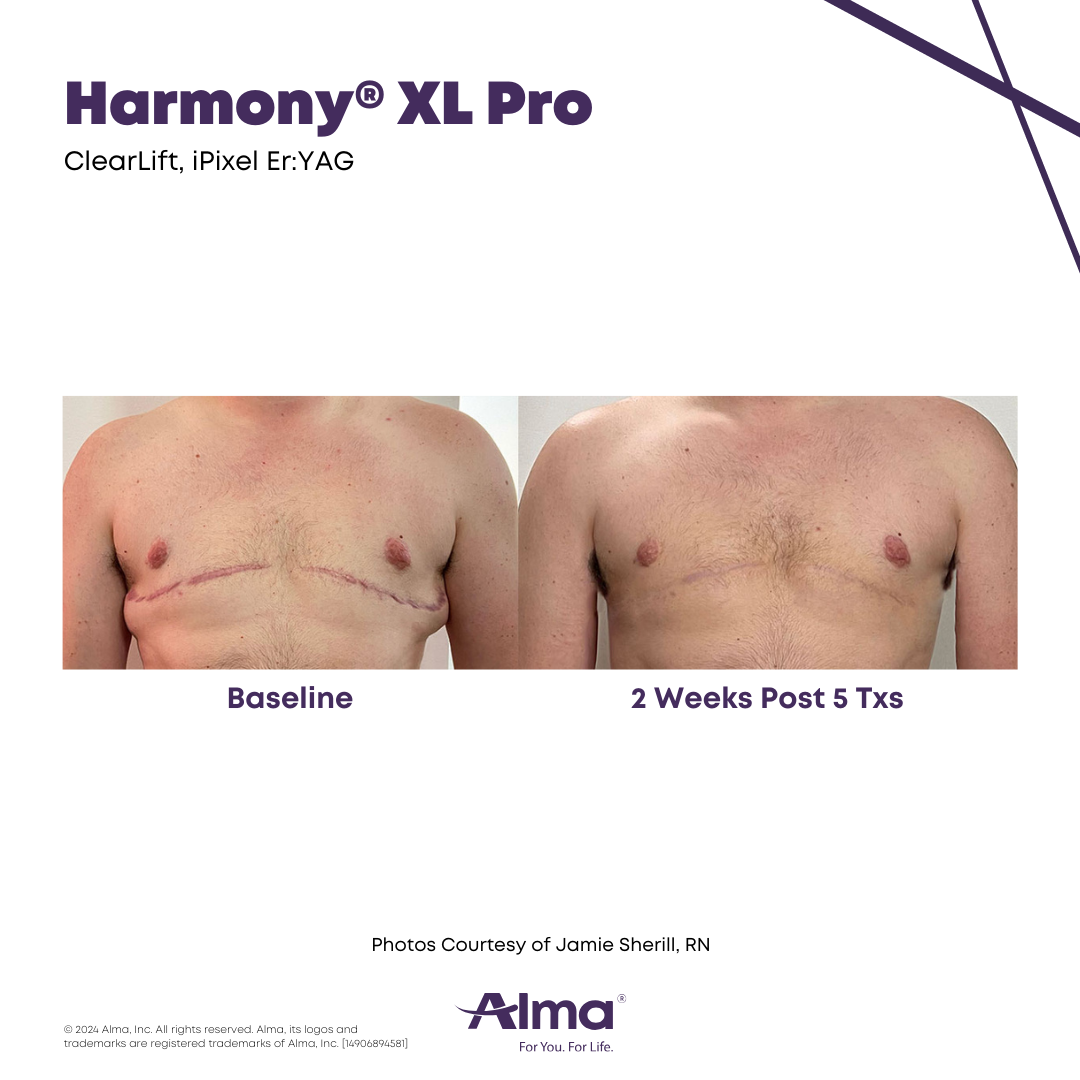 Harmony XL Pro laser skin resurfacing - treatment of scars on the chest before and 2 weeks after 5 treatments