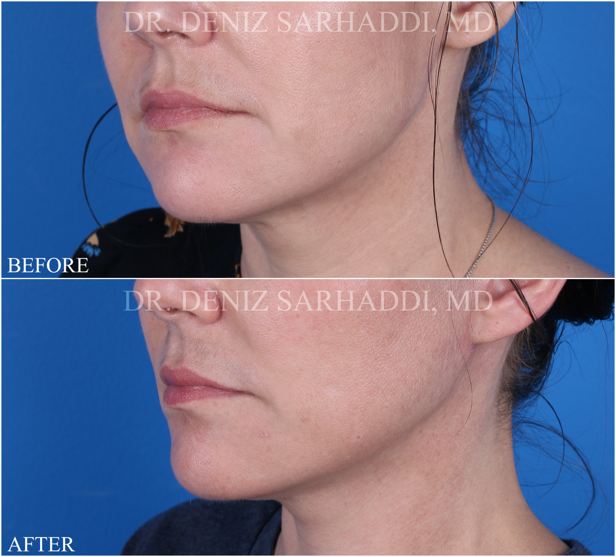 Side view of patient's before and after mini facelift procedure.