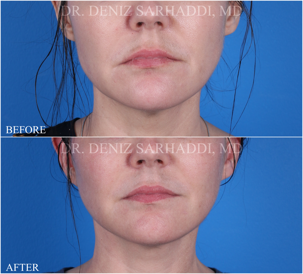 Front view of patient's before and after mini facelift procedure.